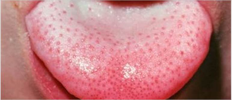Scarlet fever tongue images